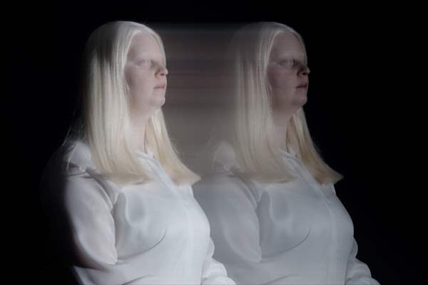 Dünya Nadir Hastalıklar Günü: 'Albino olmak'