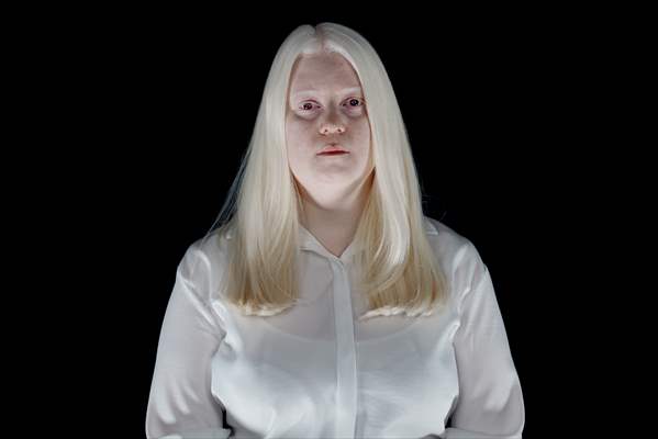 Dünya Nadir Hastalıklar Günü: 'Albino olmak'