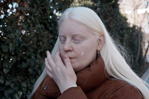 Dünya Nadir Hastalıklar Günü: 'Albino olmak'