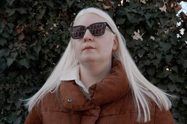 Dünya Nadir Hastalıklar Günü: 'Albino olmak'