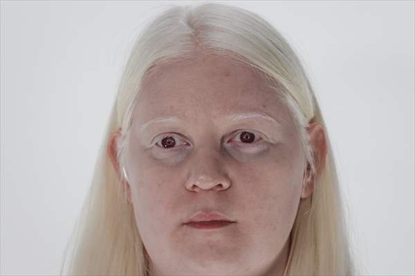 Dünya Nadir Hastalıklar Günü: 'Albino olmak'