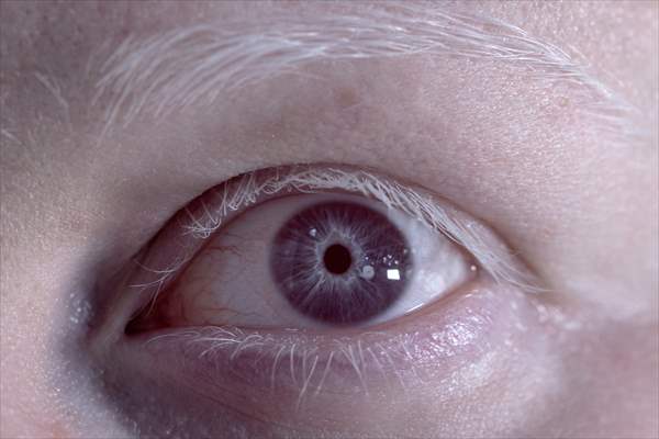 Dünya Nadir Hastalıklar Günü: 'Albino olmak'