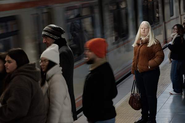 Dünya Nadir Hastalıklar Günü: 'Albino olmak'