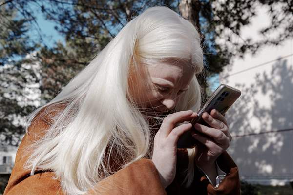 Dünya Nadir Hastalıklar Günü: 'Albino olmak'