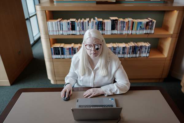 Dünya Nadir Hastalıklar Günü: 'Albino olmak'