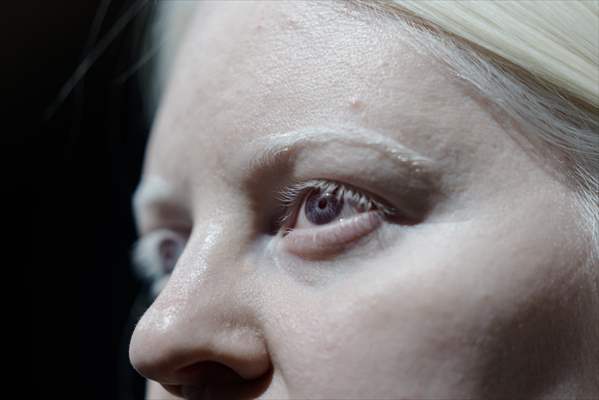 Dünya Nadir Hastalıklar Günü: 'Albino olmak'