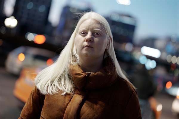 Dünya Nadir Hastalıklar Günü: 'Albino olmak'