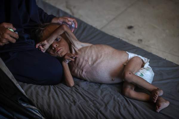 Palestinian baby in Gaza suffering from malnutrition at risk of death