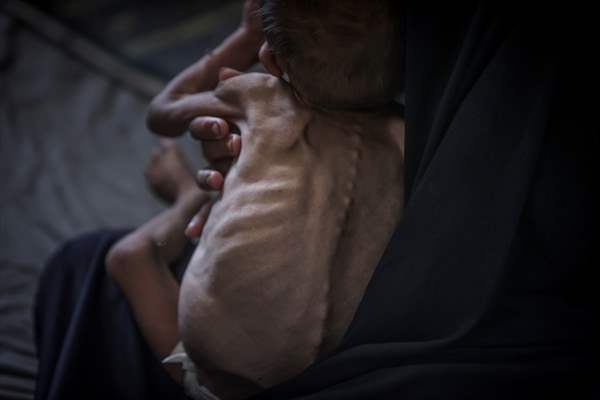 Palestinian baby in Gaza suffering from malnutrition at risk of death