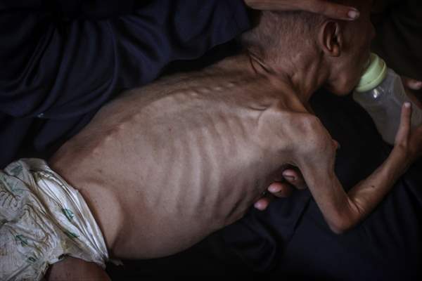 Palestinian baby in Gaza suffering from malnutrition at risk of death