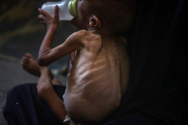 Palestinian baby in Gaza suffering from malnutrition at risk of death