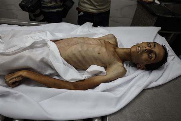 17-year-old boy dies in Gaza due to malnutrition