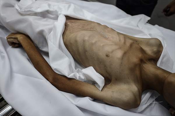 17-year-old boy dies in Gaza due to malnutrition