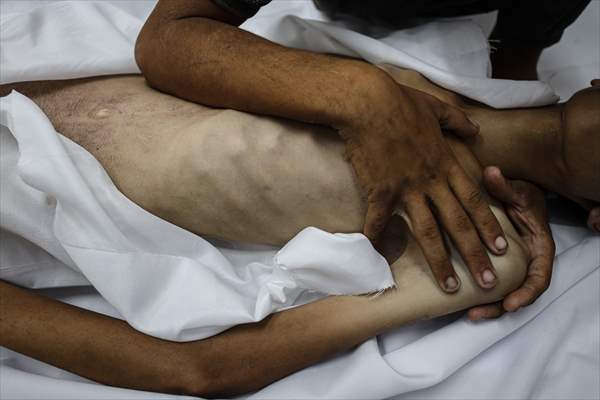 17-year-old boy dies in Gaza due to malnutrition