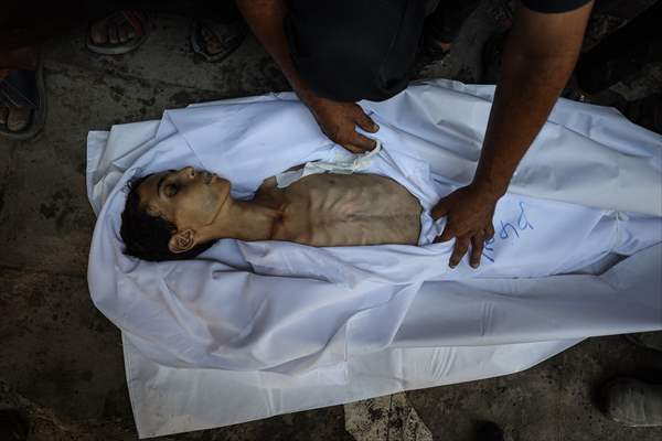 17-year-old boy dies in Gaza due to malnutrition