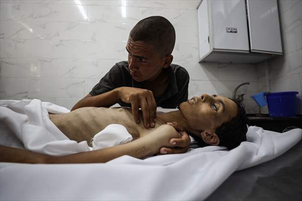 17-year-old boy dies in Gaza due to malnutrition