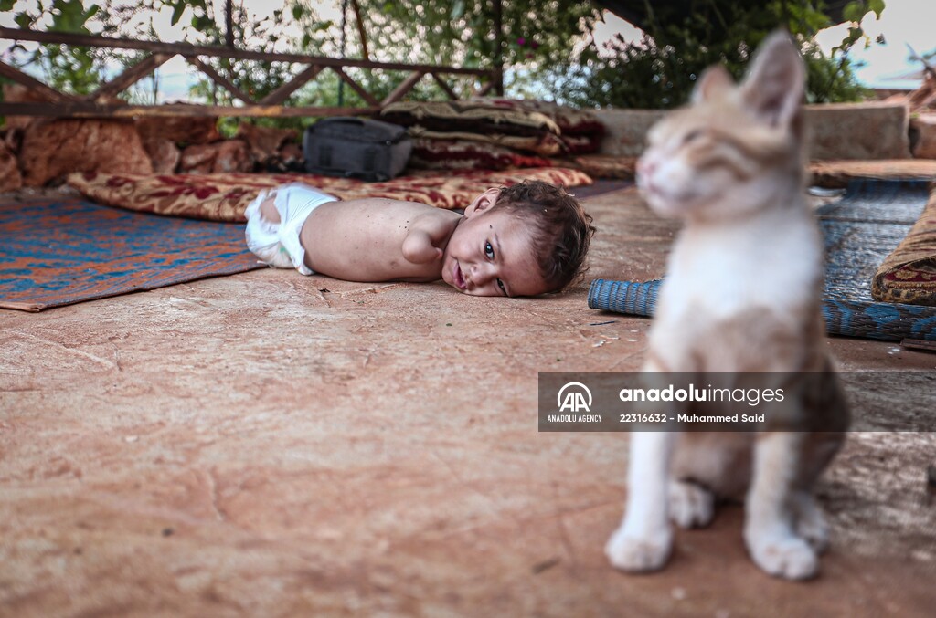 Congenital amputee child of Syrian family