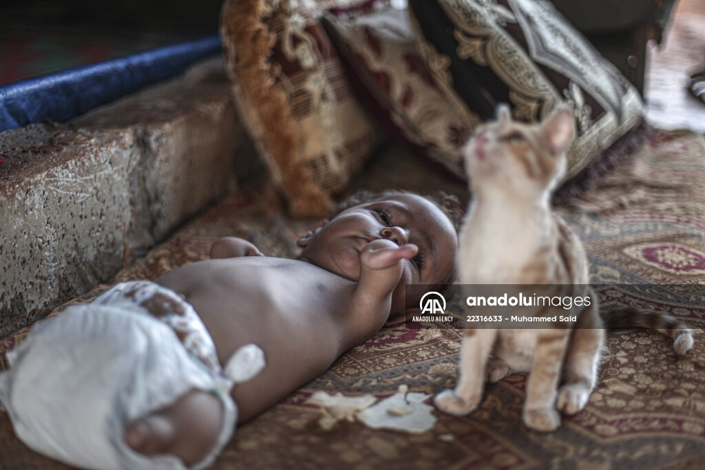 Congenital amputee child of Syrian family