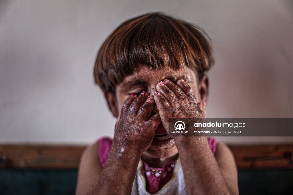 11-year-old Meryem with Pemphigus waits for help